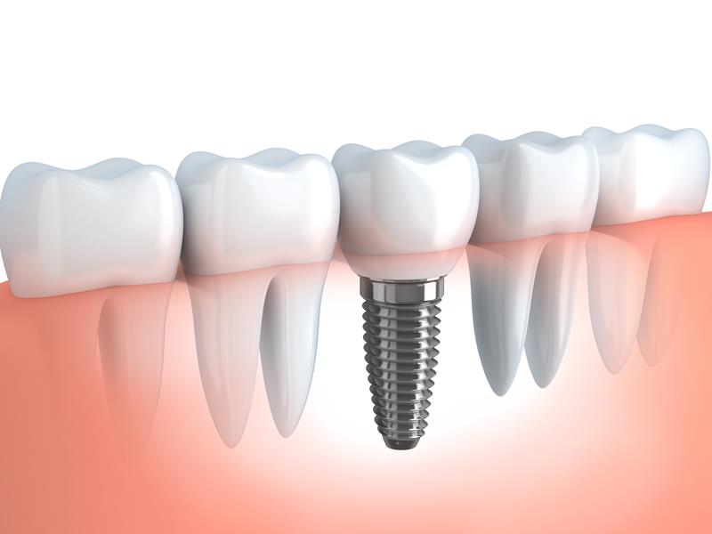 Dental Implants In side wellness Center on Thunderchild First Nation