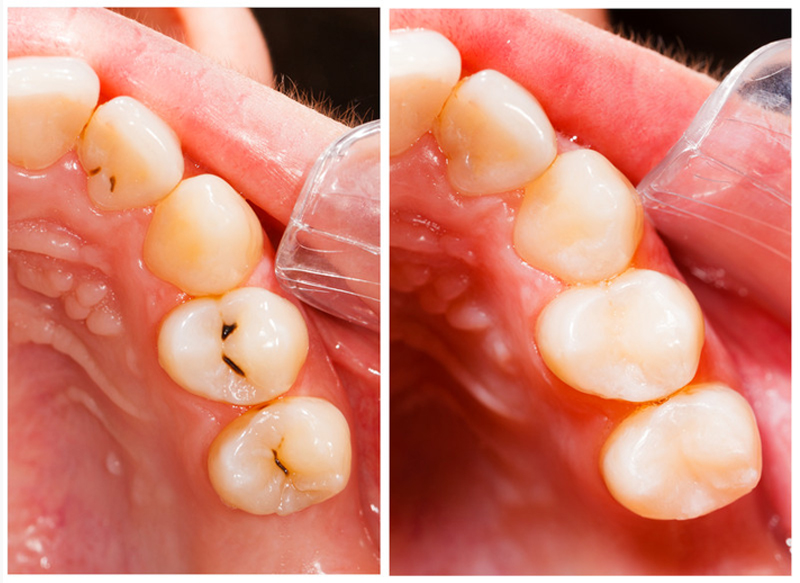 Fillings In side wellness Center on Thunderchild First Nation