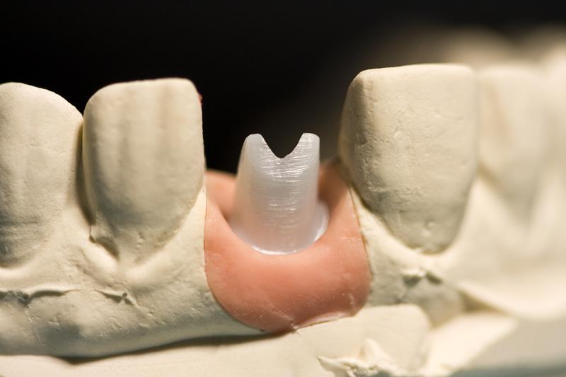 Implant Restoration In side wellness Center on Thunderchild First Nation