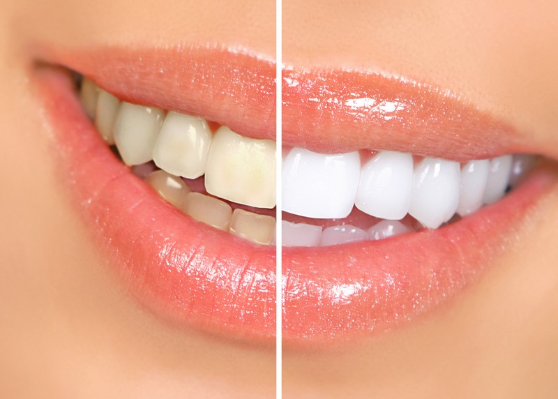 Teeth Whitening In side wellness Center on Thunderchild First Nation