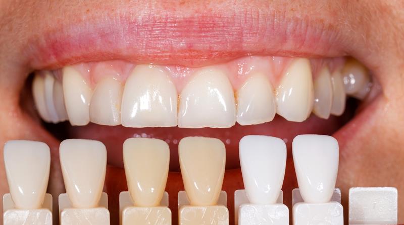 Veneers In side wellness Center on Thunderchild First Nation